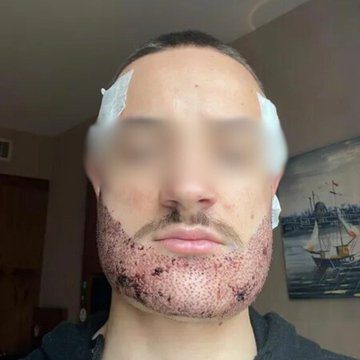 Greffe de barbe ratée en Turquie : Mathieu, 24 ans, décède trois mois après l’opération — son père témoigne