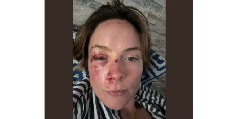 Défigurée après une chute dans le métro, elle recherche toujours son agresseur